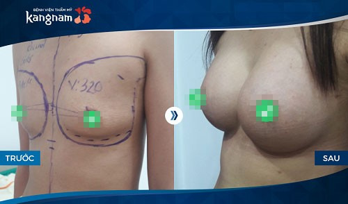 trước và sau khi sửa ngực tại bvtm kangnam